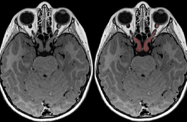 defining-biomarkers-of-vision-loss-in-common-brain-tumor-penn-medicine